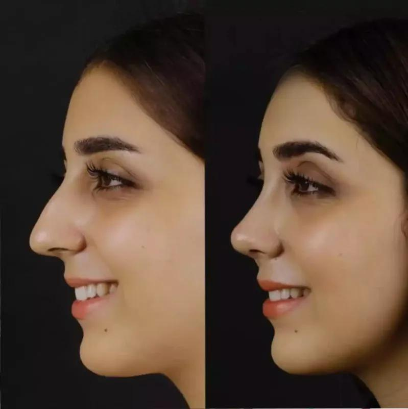 Rhinoplasty Revelations: Dubai’s Diverse Nose Reshaping Options